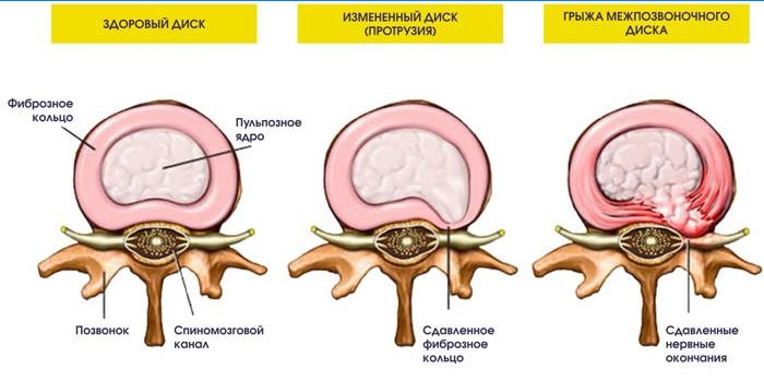 Protrusion and hernia of the intervertebral disc