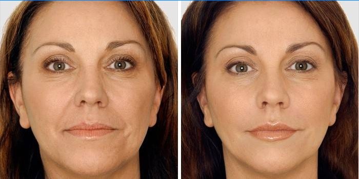 Face before and after filler correction