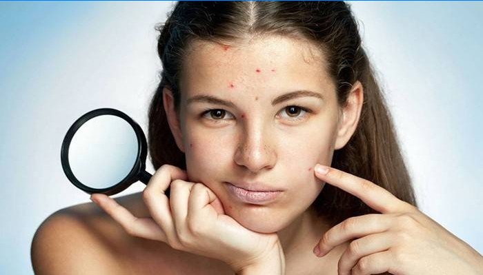 Girl with acne on her face.