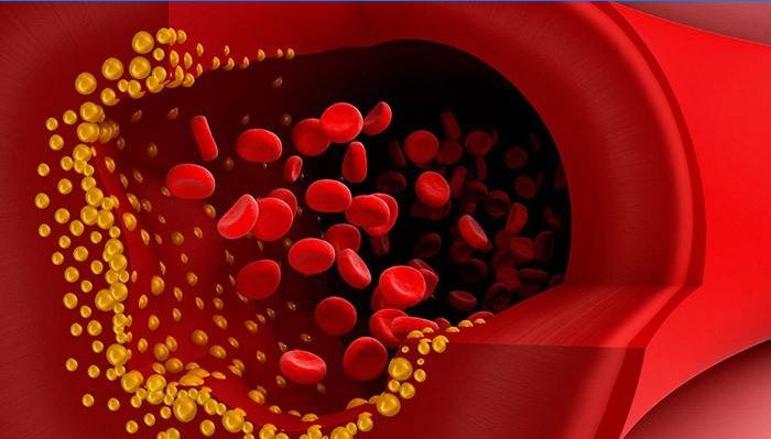 Blood cholesterol plaques
