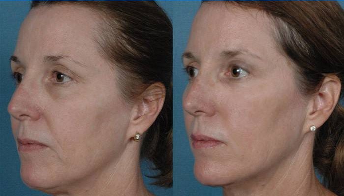 Woman's face before and after elos rejuvenation
