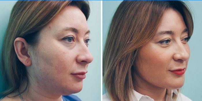 Woman before and after lipolytic injections