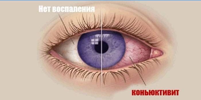 Conjunctivitis in the eye