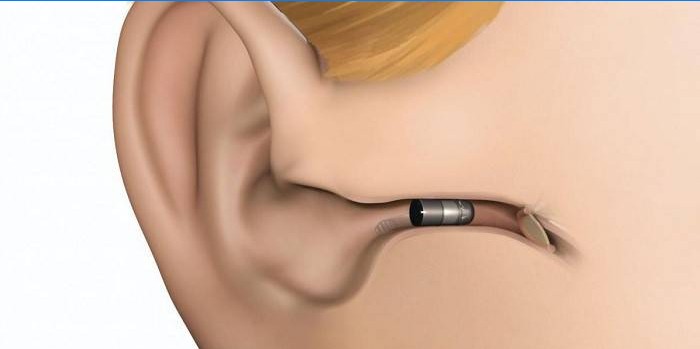 The layout of the in-ear hearing aid