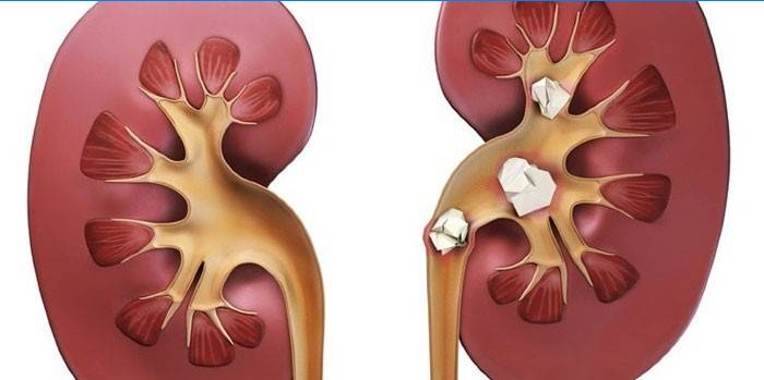 Healthy kidney and urolithiasis
