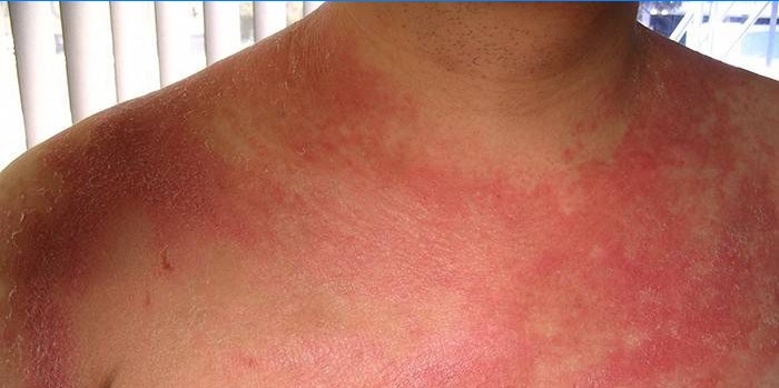 Psoriasis on the chest in a man