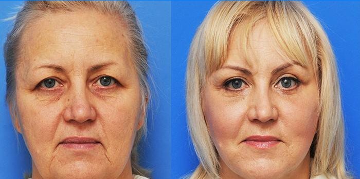 Carol Maggio Methods - Before and After Photos
