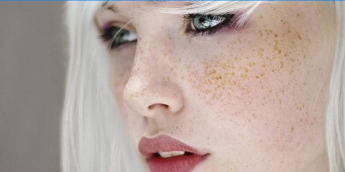 Girl with freckles on her face.