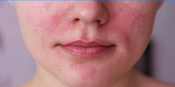 The manifestation of an allergy on the face