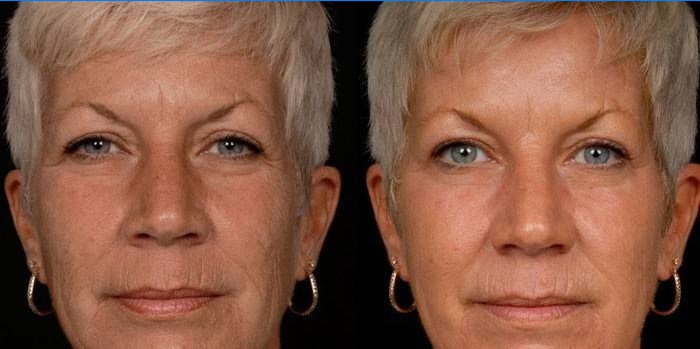 Photo of a woman before and after carboxytherapy
