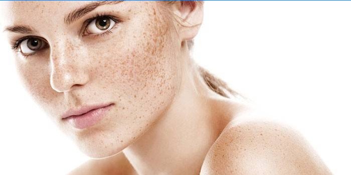 Freckles on a woman's face