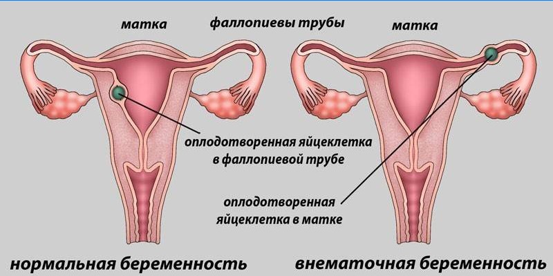 Normal and ectopic pregnancy