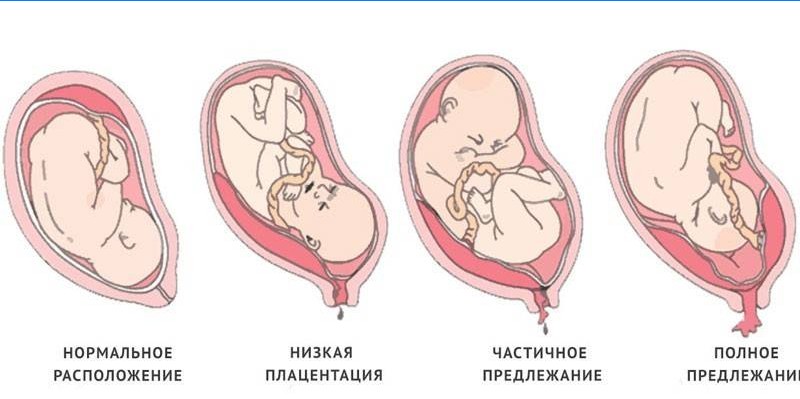 Types of placenta previa