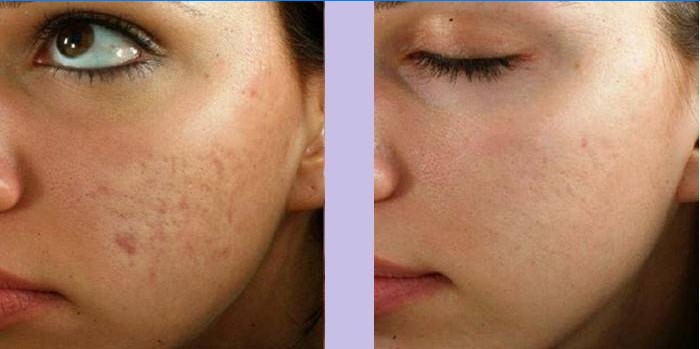 Woman's face before and after massage