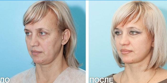 Photo of a woman before and after SMAS lifting