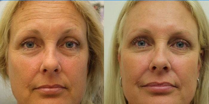 Woman's face before and after SMAS lifting