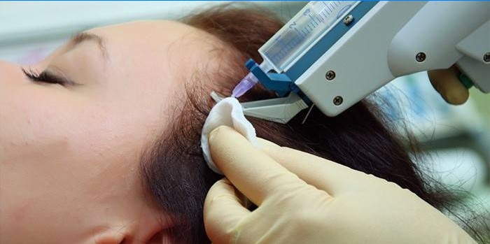 Woman undergo mesotherapy of the scalp