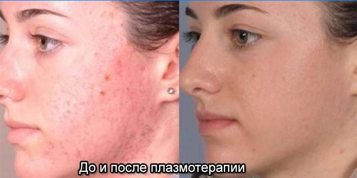 Facial skin before and after plasma therapy