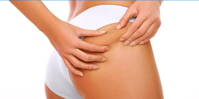 What causes stretch marks on the legs